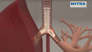 Tracheobronchial quotYquot stent MITRA OTTOMED ENDOSCOPY Interventional Pulmonology [upl. by Sirob]