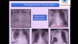 Cas Clinique sur la Pneumonie  Deuxième Partie Cours de Médecine [upl. by Neevan]