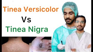 Tinea Versicolor Vs Tinea Nigra [upl. by Evita]