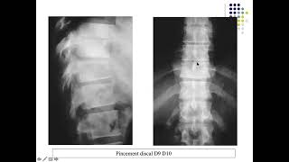 LA SPONDYLODISCITE TUBERCULEUSE ET NON TUBERCULEUSE [upl. by Mckeon]