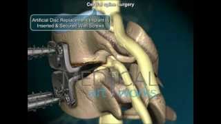 3D Medical Animation  Cervical spine artificial disc replacement and fusion comparison [upl. by Yrbua]