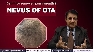 Can Nevus of OTA be Treated Permanently 100 Result of Nevus of OTA  Dr PK Talwar [upl. by Gristede]