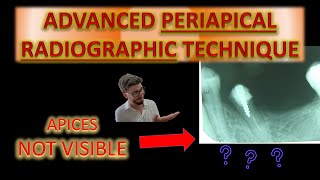 The Best Periapical X Ray Technique Angulation of Dental X Rays For Beginners How to take posterior [upl. by Olegnaleahcim]