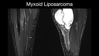 Myxoid Liposarcoma [upl. by Ezitram]