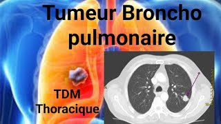 SCANNER THORACOABDOMINAL Tumeur bronchopulmonaire apicale [upl. by Saied313]