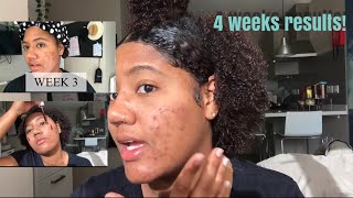 How I Use The Ordinary Peeling Solution For Hyperpigmentation Without Irritation [upl. by Sloane5]