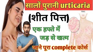 सालों पुरानी urticaria 30 दिन में जड़ से खत्म urticaria livcon capsule and assicon syrup urticaria [upl. by Yee788]