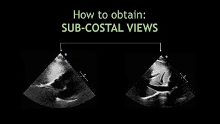 How to obtain SUBCOSTAL VIEWS Echocardiography [upl. by Herb827]