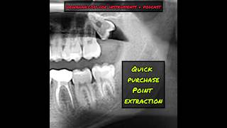 Black  White Version Quick Purchase Point Wisdom Tooth Extraction [upl. by Halfdan125]