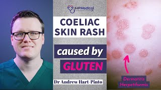 Dermatitis Herpetiformis Skin Rash Linked To Coeliac Disease Celiac And Gluten Intolerance [upl. by Yraht]