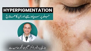 Hyperpigmentation and its treatments explained by Prof Dr Azim Jahangir Khan  Cosmetique [upl. by Ierna]