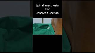 Spinal Anesthesia in Cesarean  OT stories  YouTubeShorts [upl. by Toddy]