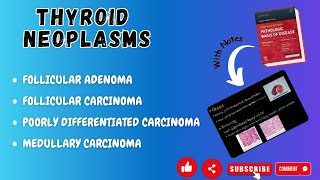 Thyroid NeoplasmFollicular Adenoma FollicularMedullaryPoorly differentiatedAnaplastic Carcinoma [upl. by Viehmann]