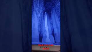 radicular cystviralshort shortvideo dentaltreatment periapical cystdentist [upl. by Abocaj]