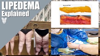 What is Lipedema and How is Lipedema Treated  Total Lipedema Care  Dr Jaime Schwartz [upl. by Snook]