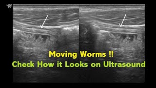 Intestinal Helminthiasis Ascariasis  Ultrasound  Case 04 [upl. by Eednam]