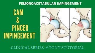 FEMEROACETABULAR IMPINGEMENT Cam amp Pincer Impingement [upl. by Einimod]