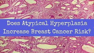 Does Atypical Hyperplasia Increase Breast Cancer Risk [upl. by Tallia837]