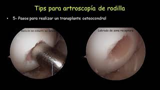 OSTEOCONDRITIS DE RODILLA TIPS f4v [upl. by English]