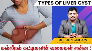 கல்லீரல் கட்டி காரணங்கள் அறிகுறிகள் சிகிச்சைகள் Types of Liver Cyst in Tamil  John Gastro Hospital [upl. by Rese218]