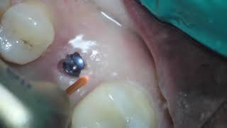 Dental Implant Uncovery Waterlase Laser Dentistry Golan [upl. by Slaohcin209]