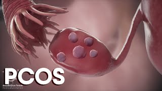 menstruation and Polycystic Ovary Syndrome or PCOS  Causes TreatmentsDandelion Medical Animation [upl. by Enwahs345]