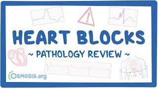 Heart blocks Pathology Review [upl. by Yanehs]