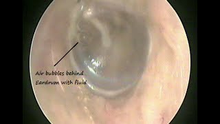 Otoendoscopy  Fluid behind Eardrum  Serous Otitis media  Glue ear  due to cold amp allergy [upl. by Ob]