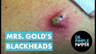 Mrs Golds Back Blackhead Extraction Session  Addressing the Inflamed One [upl. by Bj]