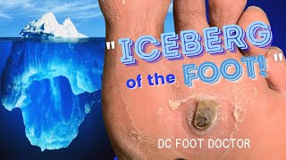 Iceberg of the Foot Removing Painful Pororkeratosis [upl. by Ginelle]