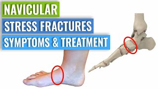 Navicular Stress Fracture Symptoms amp Treatment [upl. by Mauro160]