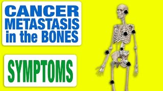 Cancer Metastasis in the Bones  All Symptoms [upl. by Rebmac728]