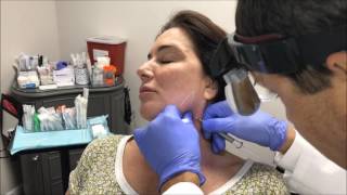 Defining the jawline with fillers [upl. by Thomsen]