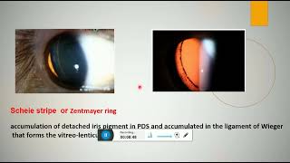 pigment dispersion syndrome and pigmentary glaucoma [upl. by Avis]