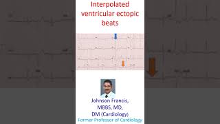 Interpolated ventricular ectopic beats [upl. by Cichocki]