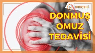 DONMUŞ OMUZ SENDROMU NEDİR [upl. by Odrareve]