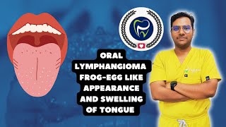 Dr Rudra Mohan  Oral Lymphangioma of the Tongue  Frog Egg like Appearance amp Swelling of theTongue [upl. by Fotina]