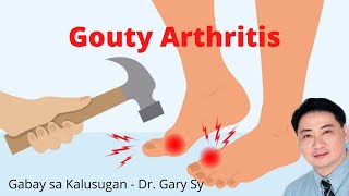 Gouty Arthritis  Dr Gary Sy [upl. by Swanhildas]