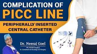 Understanding Complications and Management of Peripherally Inserted Central Catheters PICC line [upl. by Sansen]