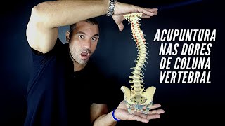 Acupuntura nas dores da coluna vertebral [upl. by Cleave]