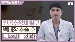 백내장 수술 후 나타날 수 있는 인공수정체 탈구 수술 꼭 해야 하나요 [upl. by Rohpotsirhc]