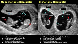 Anatomy of monochorionic diamniotic twin pregnancy twin anatomy pregnancy twinpregnancy [upl. by Adihahs]