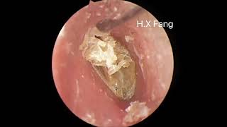 Ear wax removalFungus cleaning 耳垢清除和真菌清理20230906 [upl. by Nibaj781]