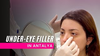 UnderEye Filler  Antalya  DK Klinik [upl. by Murtha]