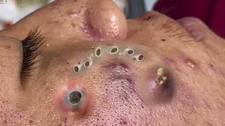 Big Cystic Acne Blackheads Extraction Blackheads amp Milia Whiteheads Removal Pimple Popping 090 [upl. by Suolkcin584]