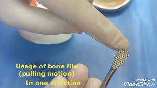 Removal of sharp bony spiculesedges after tooth extraction few minutes of oral surgery [upl. by Novick635]