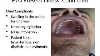 Case Presentation Adenoid cystic carcinoma of Minor salivary glads [upl. by Page770]