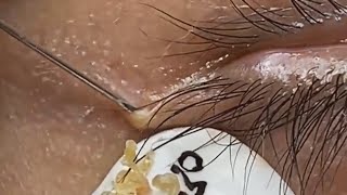 Deep blackhead extraction Cystic acne amp pimple popping 95 [upl. by Anomis]