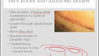 cesarean section  description indications and questions [upl. by Faubion]