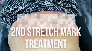 stretch mark removal treatment update E2 sublative laser [upl. by Eelarol]